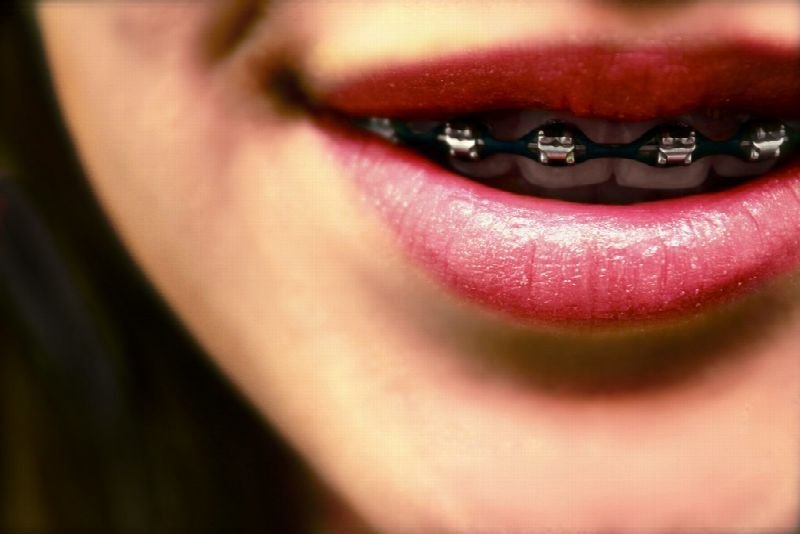 Close-up of a smile with orthodontic braces